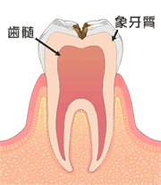 C2　象牙質にまで虫歯が進行