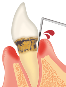 歯周病の歯ぐき