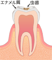 Ｃ１の虫歯　エナメル質が脱灰