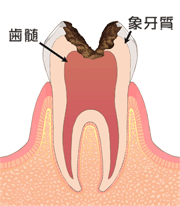 Ｃ３　虫歯が大きな穴になって象牙質全てに及ぶ