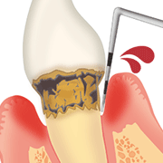 歯周病のイラスト